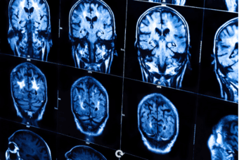 Participate in a Stanford Chronic Pain Study and Receive $200 Cash 2